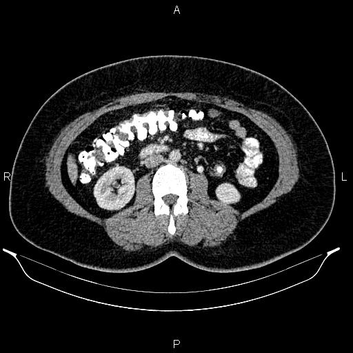 Bilateral ovarian dermoid cysts (Radiopaedia 85785-101603 A 54).jpg
