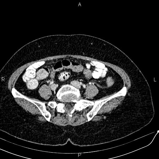Bilateral ovarian serous cystadenocarcinoma (Radiopaedia 86062-101989 B 71).jpg