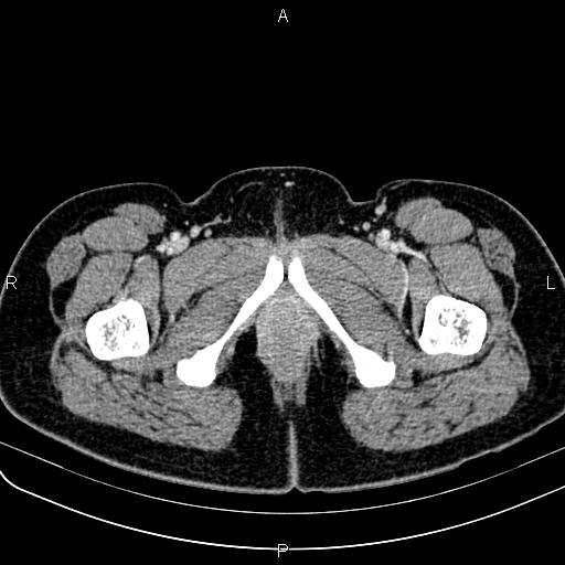 Bilateral ovarian teratoma (Radiopaedia 83131-97503 Axial With contrast 88).jpg