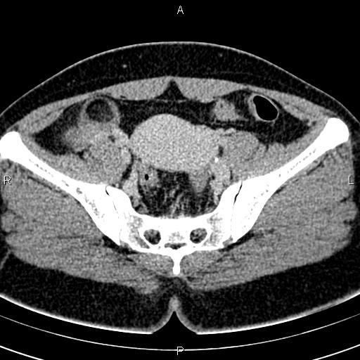 File:Bilateral ovarian teratoma (Radiopaedia 83131-97503 B 31).jpg