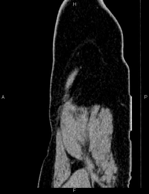 Bilateral ovarian teratoma (Radiopaedia 83131-97503 D 15).jpg