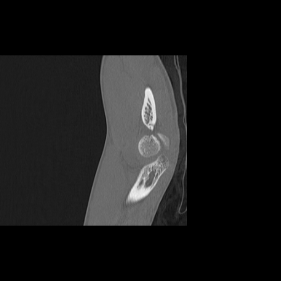File:Bilateral proximal radioulnar synostosis (Radiopaedia 66532-75812 B 15).jpg