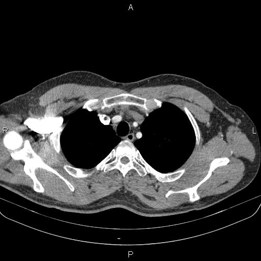 Bilateral pulmonary AVM (Radiopaedia 83134-97505 A 13).jpg