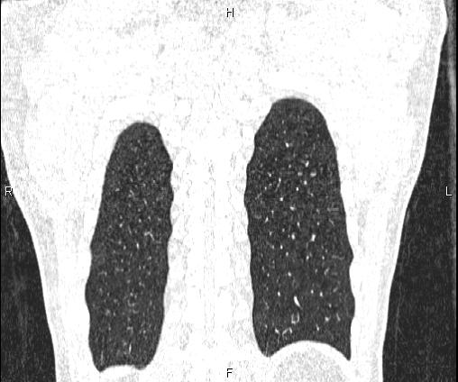 Bilateral pulmonary AVM (Radiopaedia 83134-97505 Coronal lung window 70).jpg
