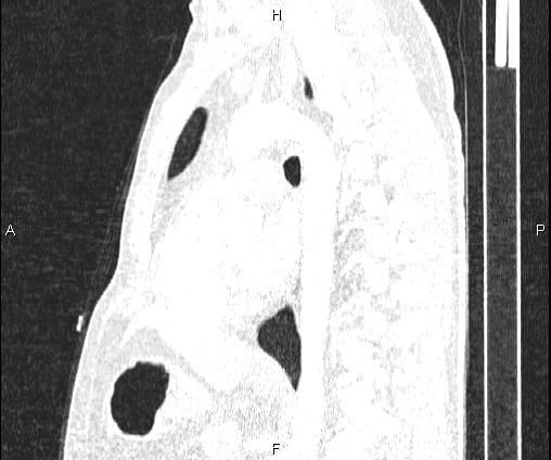Bilateral pulmonary AVM (Radiopaedia 83134-97505 Sagittal lung window 65).jpg