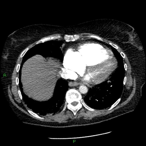 Bilateral pulmonary emboli (Radiopaedia 32700-33669 Axial C+ CTPA 81).jpg