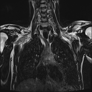 Bilateral spinoglenoid notch ganglion cysts (Radiopaedia 29577-30082 Coronal T2 49).jpg