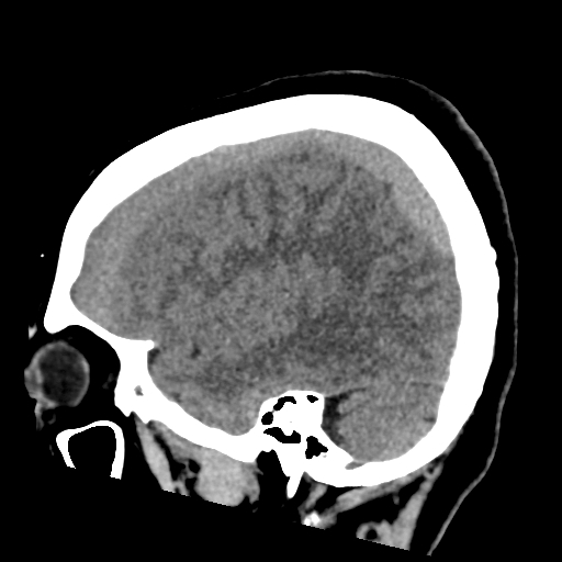 File:Bilateral subacute subdural hematoma (Radiopaedia 69240-79018 C 39).jpg