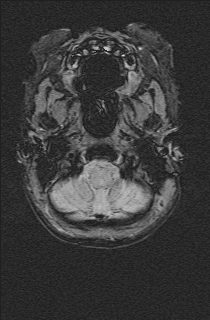 File:Bilateral subdural hemorrhage and parietal skull fracture (Radiopaedia 26058-26190 Axial SWI 5).png