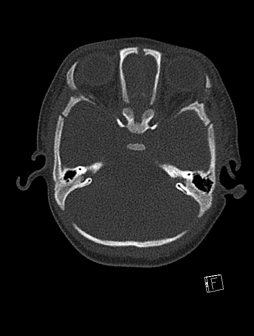 Bilateral subdural hemorrhage and parietal skull fracture (Radiopaedia 26058-26192 Axial bone window 101).png