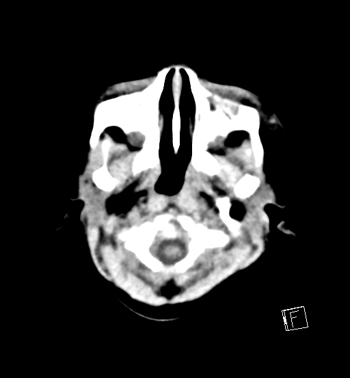 File:Bilateral subdural hemorrhage and parietal skull fracture (Radiopaedia 26058-26192 Axial non-contrast 24).png