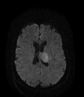 File:Bilateral thalamic glioma (Radiopaedia 65852-75009 Axial DWI 13).jpg