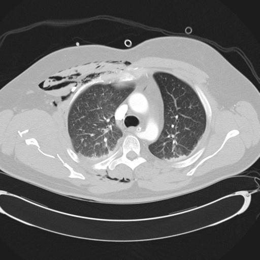 Bilateral traumatic renovascular injury (Radiopaedia 32051-32995 Axial lung window 18).jpg