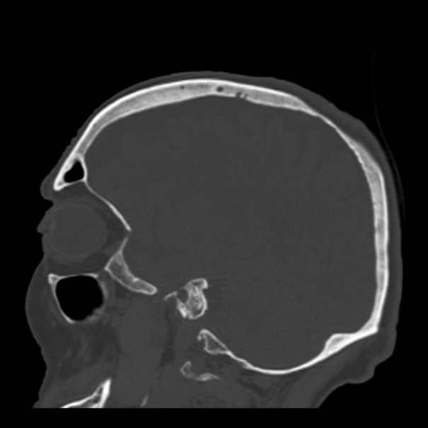 Biparietal osteodystrophy (Radiopaedia 46109-50463 Sagittal bone window 36).jpg