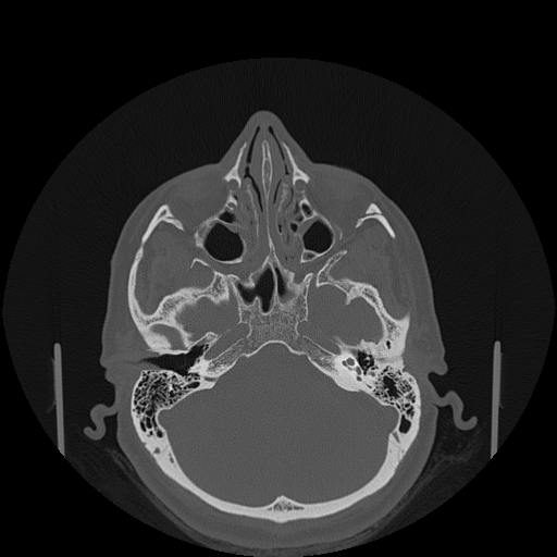 File:Bisphosphonate-related osteonecrosis of the jaw (Radiopaedia 71324-81642 Axial bone window 163).jpg