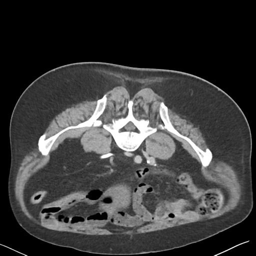 File:Bladder papillary urothelial carcinoma (Radiopaedia 48119-52951 Axial C+ delayed 36).png