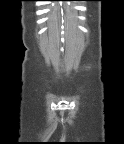 File:Bladder rupture post renal biopsy (Radiopaedia 30863-31572 Coronal non-contrast 52).jpg
