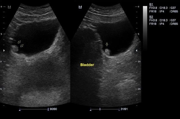 File:Bladder tumor and atypical renal cyst (Radiopaedia 16992-16699 B 1).jpg