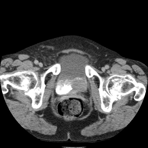 Bladder tumor detected on trauma CT (Radiopaedia 51809-57609 C 137).jpg