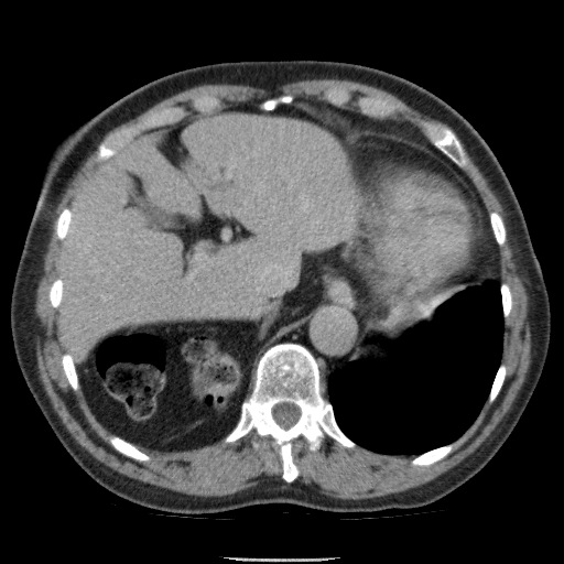 Bladder tumor detected on trauma CT (Radiopaedia 51809-57609 C 28).jpg