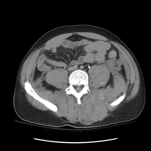 Blunt abdominal trauma with solid organ and musculoskelatal injury with active extravasation (Radiopaedia 68364-77895 Axial C+ delayed 90).jpg