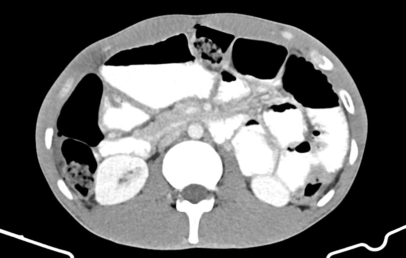 Blunt injury to the small bowel (Radiopaedia 74953-85987 A 67).jpg