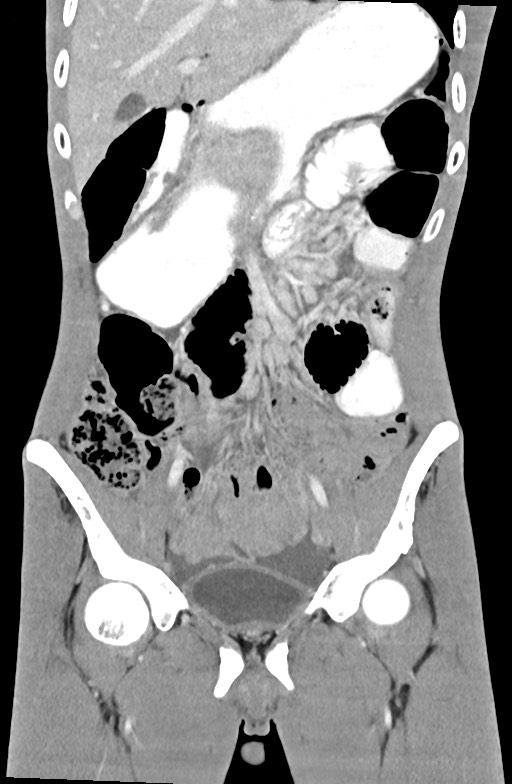 Blunt injury to the small bowel (Radiopaedia 74953-85987 B 38).jpg