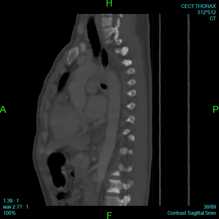 Bone metastases from lung carcinoma (Radiopaedia 54703-60937 Sagittal bone window 38).jpg