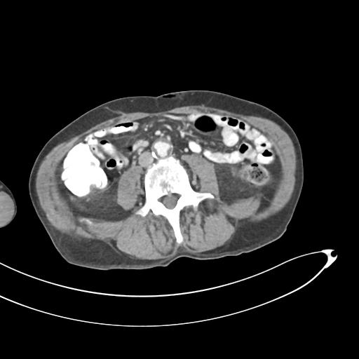 Bone metastasis from squamous cell carcinoma (Radiopaedia 30133-30730 B 42).jpg