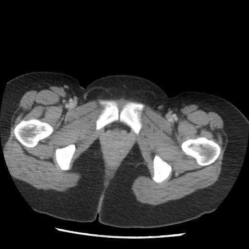 File:Borderline mucinous tumor (ovary) (Radiopaedia 78228-90808 A 141).jpg