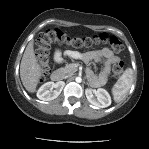 File:Borderline mucinous tumor (ovary) (Radiopaedia 78228-90808 A 52).jpg