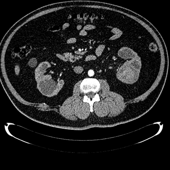 Bosniak renal cyst - type IV (Radiopaedia 24244-24518 B 165).jpg