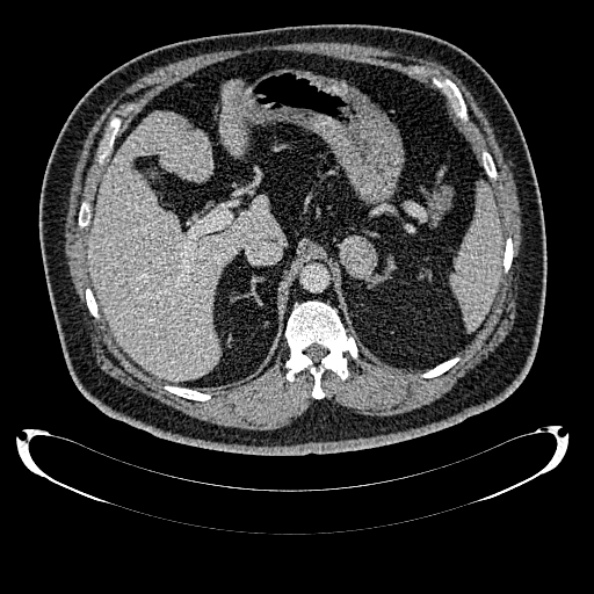 Bosniak renal cyst - type IV (Radiopaedia 24244-24518 C 78).jpg