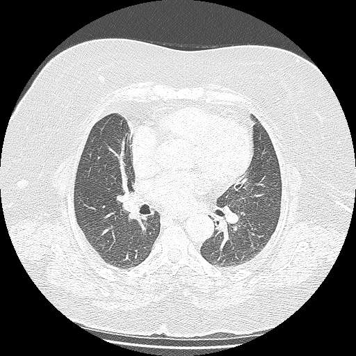 Bovine aortic arch - right internal mammary vein drains into the superior vena cava (Radiopaedia 63296-71875 Axial lung window 85).jpg