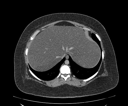 Bowel and splenic infarcts in acute lymphocytic leukemia (Radiopaedia 61055-68913 A 25).jpg