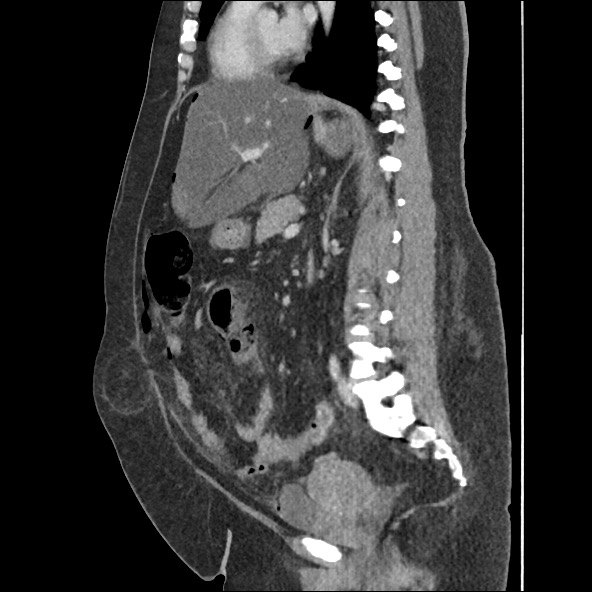 Bowel and splenic infarcts in acute lymphocytic leukemia (Radiopaedia 61055-68915 C 33).jpg