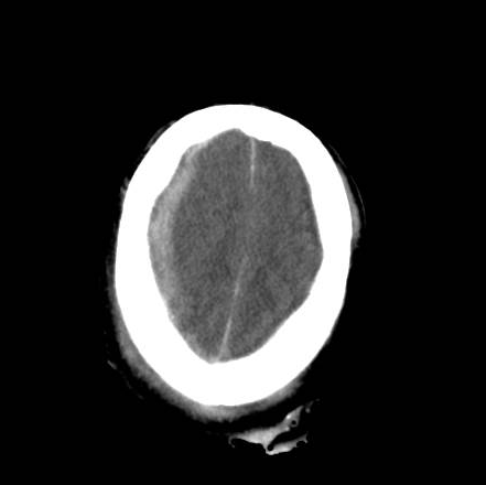 File:Brain death after motor vehicle collision (Radiopaedia 88470-105114 Axial 22).png