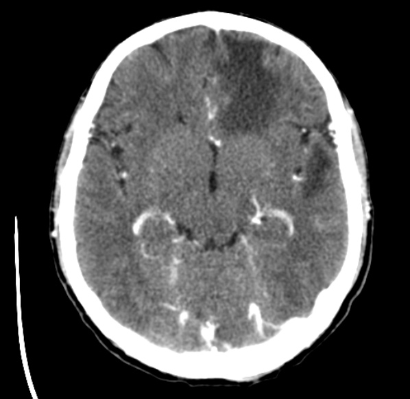File:Brain metastases from lung cancer (Radiopaedia 24480-24781 Axial C+ delayed 24).jpg