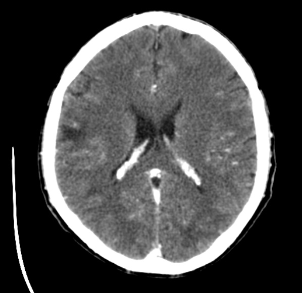 File:Brain metastases from lung cancer (Radiopaedia 24480-24781 Axial C+ delayed 36).jpg