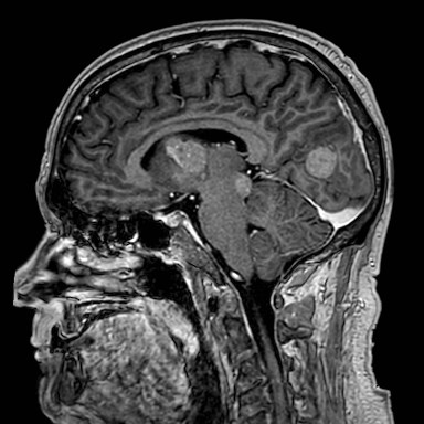 Brain metastases from lung cancer (Radiopaedia 83839-99028 Sagittal T1 C+ 29).jpg