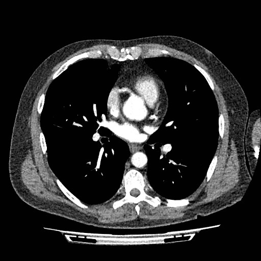 File:Brain metastases from lung cancer (Radiopaedia 83839-99030 B 53).jpg
