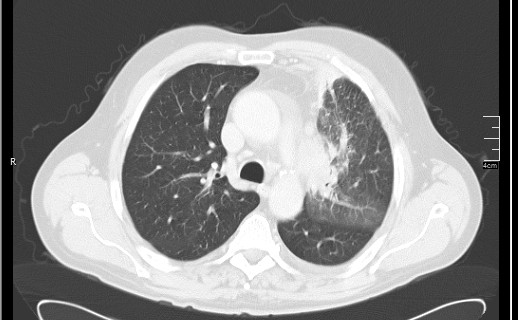 Brain metastases from squamocellular lung cancer (Radiopaedia 56515-63219 Axial lung window 26).jpg