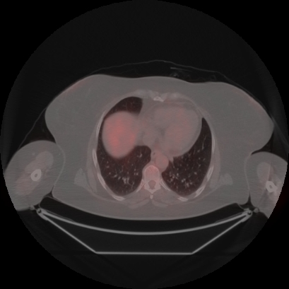 Brain metastasis (Radiopaedia 89847-106962 Axial lung window 43).jpg