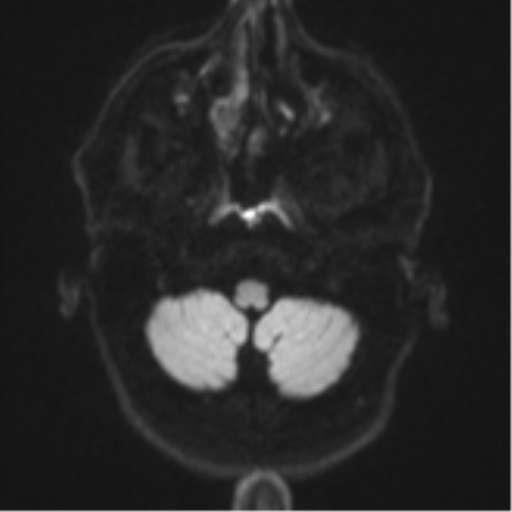 Brain metastasis (large cystic mass) (Radiopaedia 47497-52107 Axial DWI 31).png