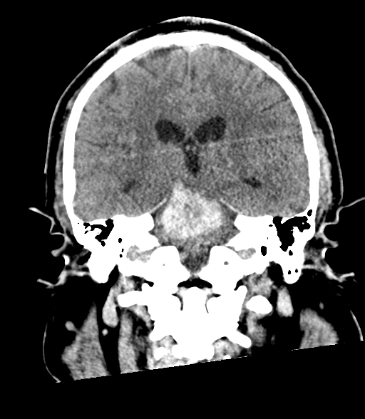 Brainstem hemorrhage (Radiopaedia 81294-94976 Coronal non-contrast 40).jpg