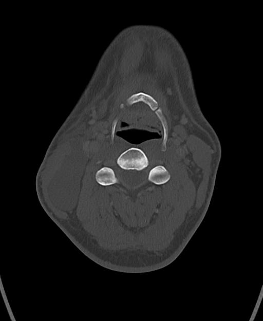 Branchial cleft cyst (Radiopaedia 31167-31875 Axial bone window 35).jpg