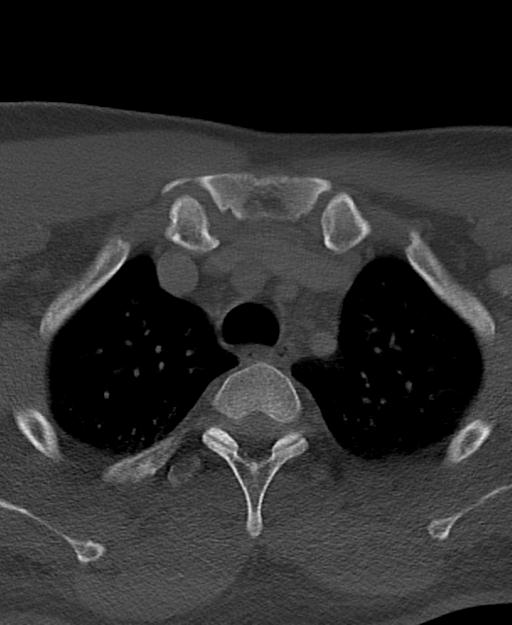 Branchial cleft cyst (Radiopaedia 31167-31875 Axial bone window 77).jpg