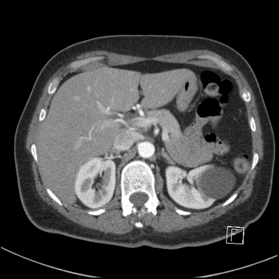 File:Breast metastases from renal cell cancer (Radiopaedia 79220-92225 A 95).jpg
