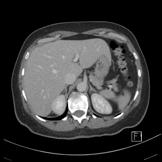 Breast metastases from renal cell cancer (Radiopaedia 79220-92225 C 20).jpg