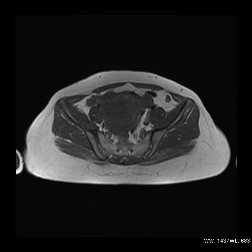 File:Broad ligament fibroid (Radiopaedia 49135-54241 Axial T1 8).jpg